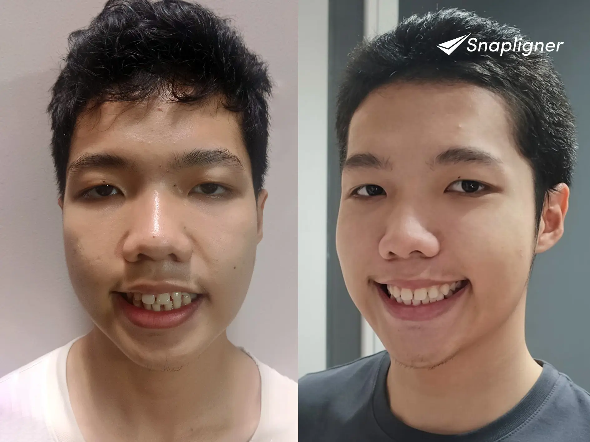 Before after hasil Snapligner clear aligner, koreksi gigi depan Smile Zone lebih rapi dan senyum estetik