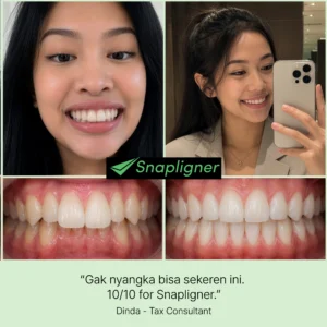 testimonial aligner gigi snapligner Dinda, gigi deep bite jadi rapi