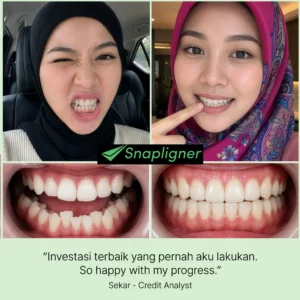 testimonial aligner gigi snapligner Sekar, gigi crowding jadi rapi